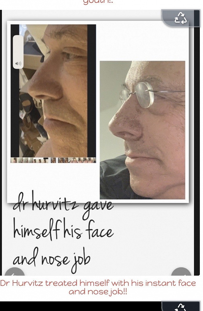 Dr Hurvitz gave himself his instant facelift and nose job!