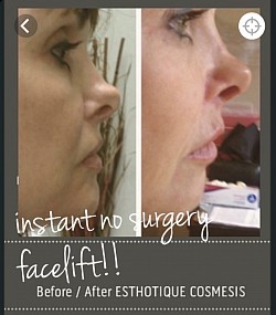 Instant facelift and nose job without surgery.