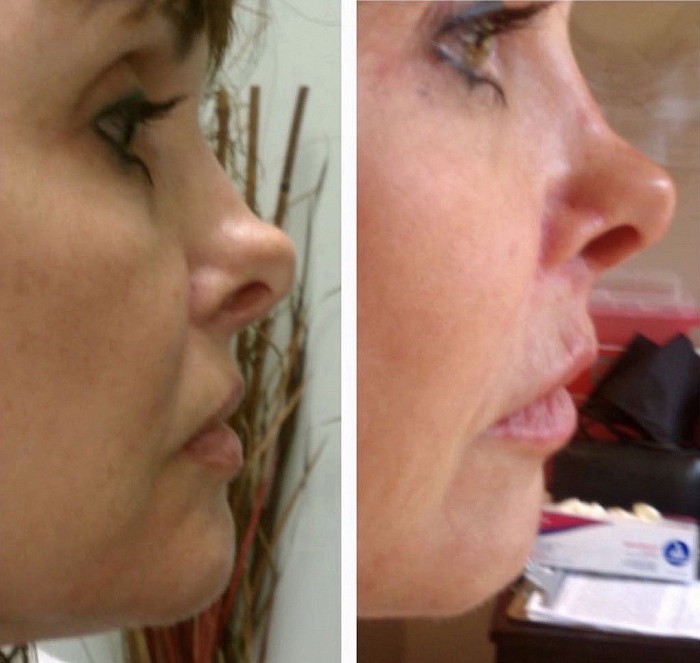 Instant Facelift and Nose job on Patient 3152.  Patient is thrilled with results. She is aware of chin to lower lip to upper lip to nasal tip 37.5 degree angle she had as a child. She knows that Dr Hurvitz giving her back this “beauty angle” to her face along with appearance of maxillary advancement, removal of naso-labial golds, increased nasal projection, apparent shorter and smaller nose and apparent rhinoplasty all contribute to her new and exciting youthful appearance and her great feeling of self confidence because she knows she is ever so attractive now!