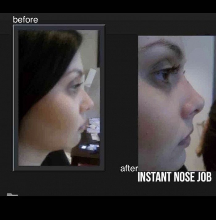 Amazing instant nose job Dr Hurvitz performed nine years ago!  The patient was thrilled with the results!