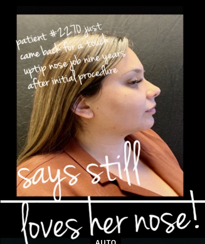 The same patient as above returned after nine years for a touch up ESTHOTIQUE non-surgical nose job by Dr Hurvitz and she “Still Loves Her Nose”!
