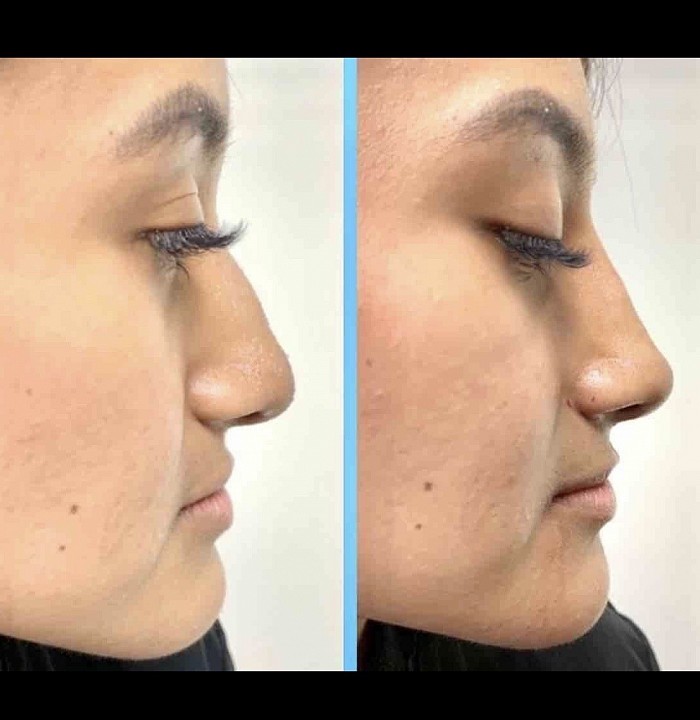 Another very satisfied patient of Dr Hurvitz who underwent the instant Esthotique nose job. She is pleased beyond words and thanks Dr Hurvitz so very much for giving  her a beautiful nose!