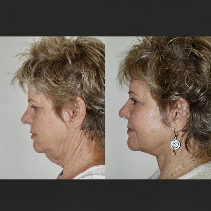 A Standard Face lift seen above ( not performed by Dr Hurvitz) only remedies neck skin and cannot impart the look of youth that only the ESTHOTIQUE TECHNOLOGY PROCEDURE of DR HURVITZ can and does do.